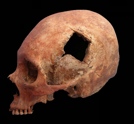 Skull Surgery-Trepanation Among the Incas
